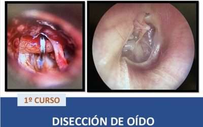 Segundo Curso de Disección de Oído