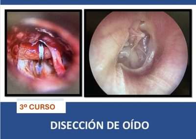 Curso de Disección de Oído